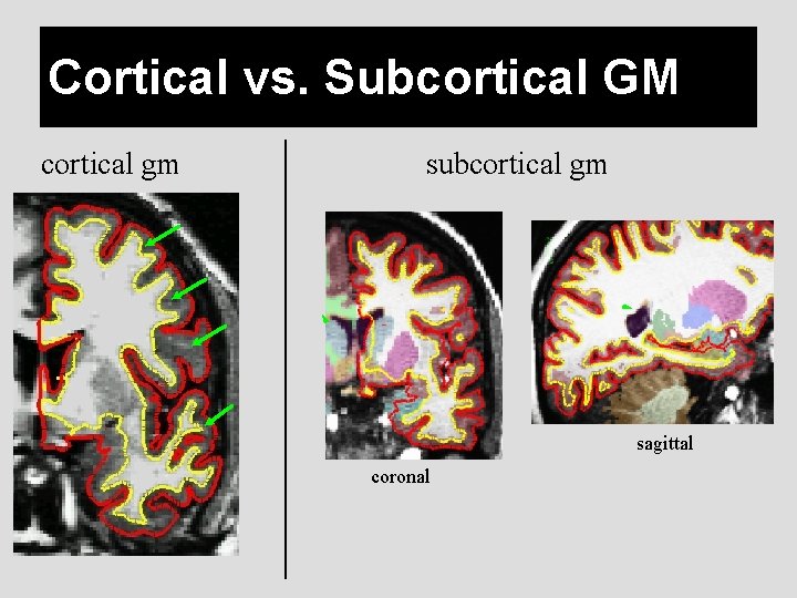 Cortical vs. Subcortical GM cortical gm subcortical gm sagittal coronal 