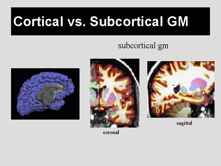 Cortical vs. Subcortical GM subcortical gm sagittal coronal 