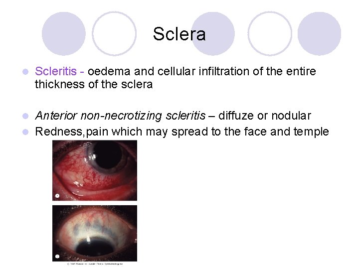 Sclera l Scleritis - oedema and cellular infiltration of the entire thickness of the