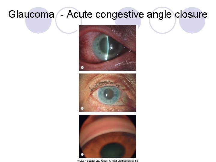 Glaucoma - Acute congestive angle closure 