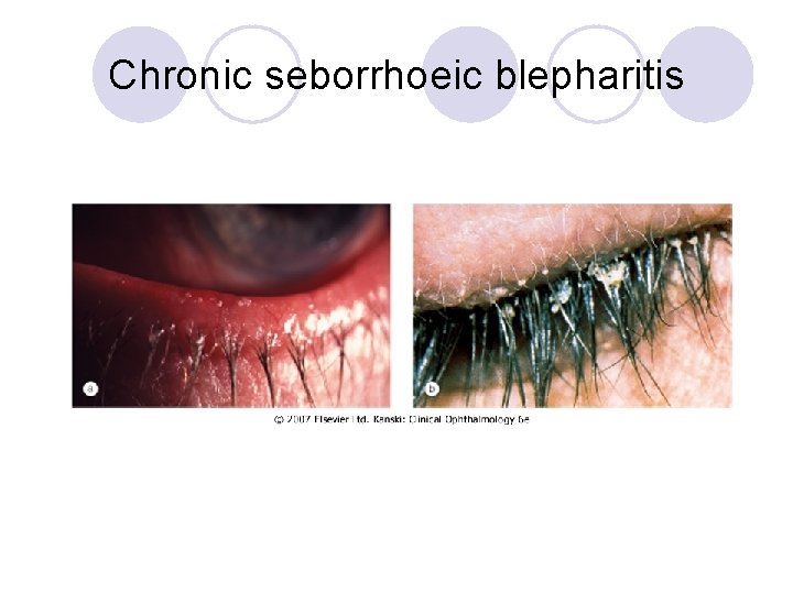 Chronic seborrhoeic blepharitis 