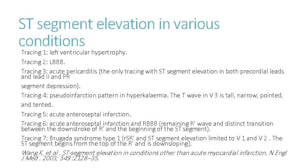 ST segment elevation in various conditions Tracing 1: left ventricular hypertrophy. Tracing 2: LBBB.