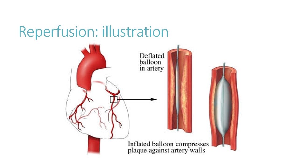 Reperfusion: illustration 