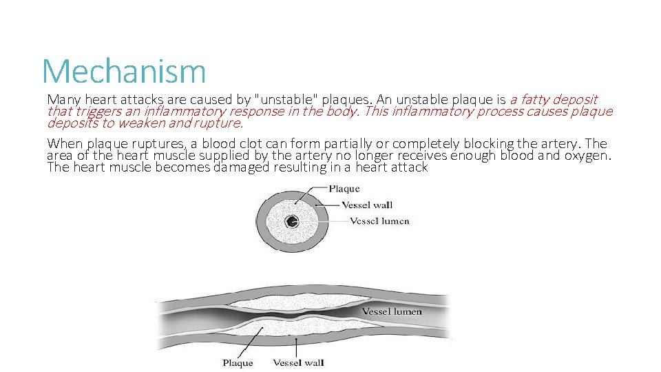 Mechanism Many heart attacks are caused by "unstable" plaques. An unstable plaque is a