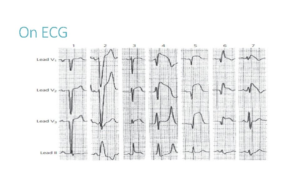 On ECG 