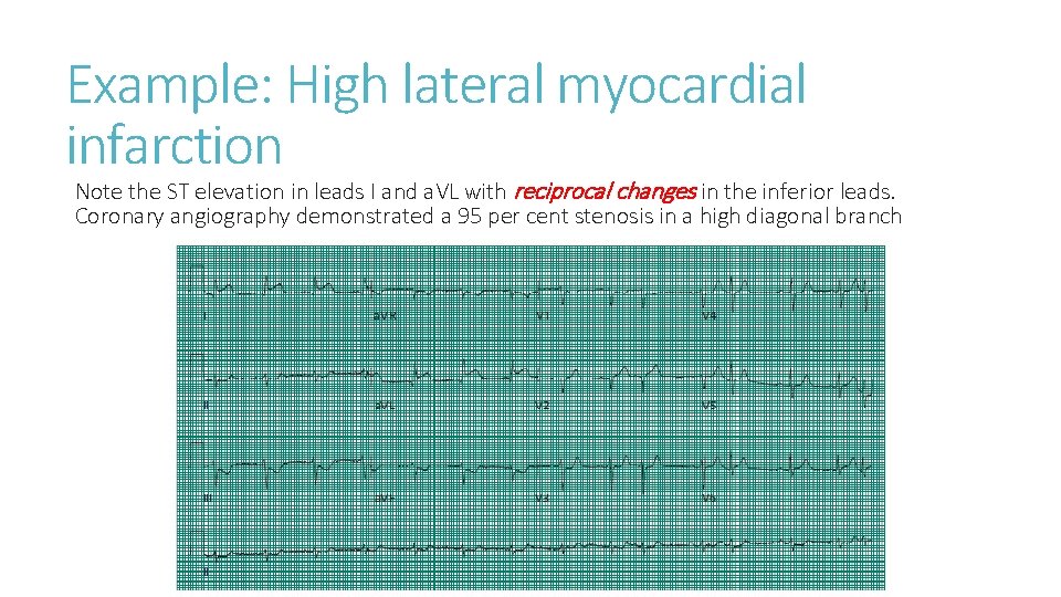 Example: High lateral myocardial infarction Note the ST elevation in leads I and a.