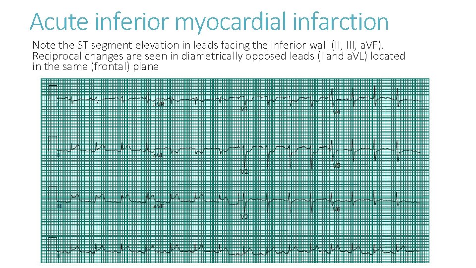 Acute inferior myocardial infarction Note the ST segment elevation in leads facing the inferior