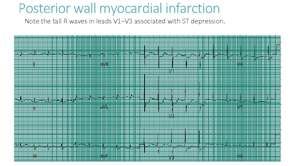 Posterior wall myocardial infarction Note the tall R waves in leads V 1–V 3