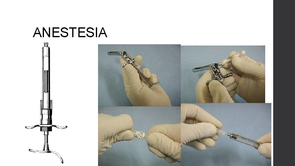 ANESTESIA 