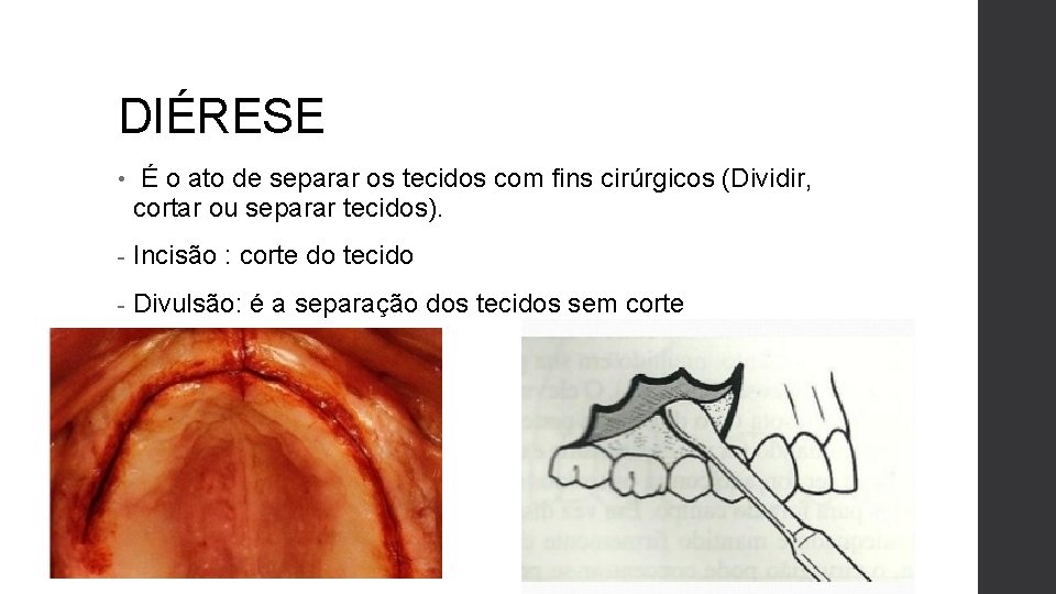DIÉRESE • É o ato de separar os tecidos com fins cirúrgicos (Dividir, cortar