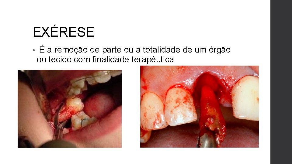EXÉRESE • É a remoção de parte ou a totalidade de um órgão ou