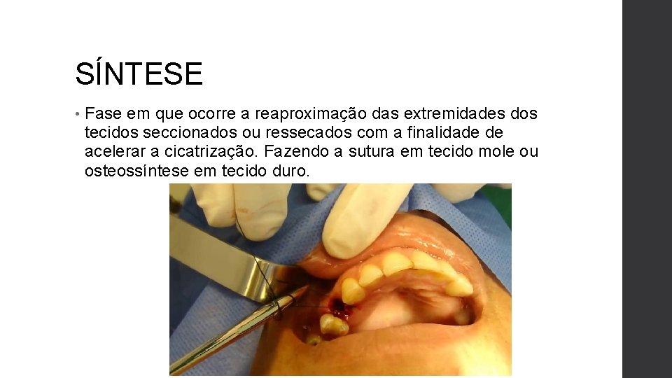 SÍNTESE • Fase em que ocorre a reaproximação das extremidades dos tecidos seccionados ou