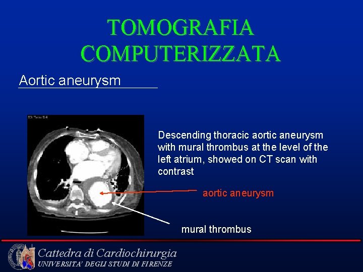 TOMOGRAFIA COMPUTERIZZATA Aortic aneurysm Descending thoracic aortic aneurysm with mural thrombus at the level