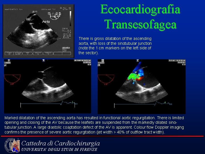 Ecocardiografia Transesofagea There is gross dilatation of the ascending aorta, with loss of the
