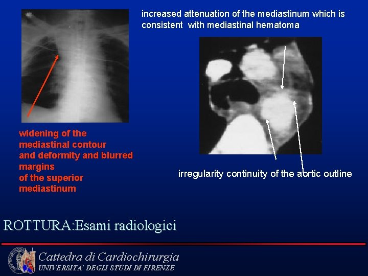 increased attenuation of the mediastinum which is consistent with mediastinal hematoma widening of the