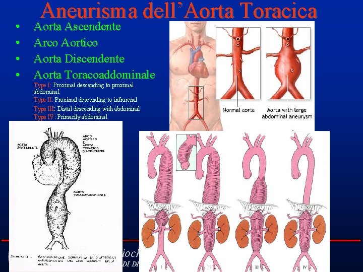  • • Aneurisma dell’Aorta Toracica Aorta Ascendente Arco Aortico Aorta Discendente Aorta Toracoaddominale