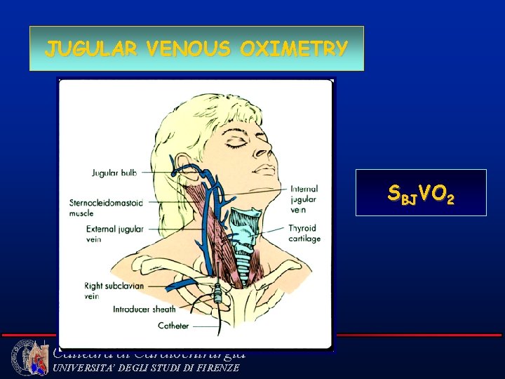 JUGULAR VENOUS OXIMETRY SBJVO 2 Cattedra di Cardiochirurgia UNIVERSITA’ DEGLI STUDI DI FIRENZE 