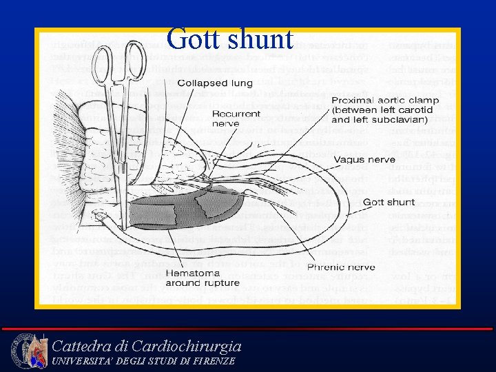 Gott shunt Cattedra di Cardiochirurgia UNIVERSITA’ DEGLI STUDI DI FIRENZE 
