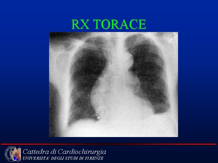 RX TORACE Cattedra di Cardiochirurgia UNIVERSITA’ DEGLI STUDI DI FIRENZE 