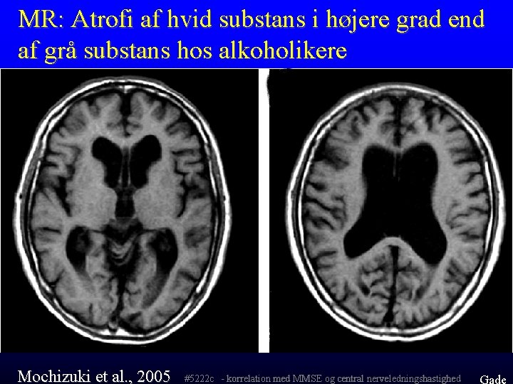 MR: Atrofi af hvid substans i højere grad end af grå substans hos alkoholikere