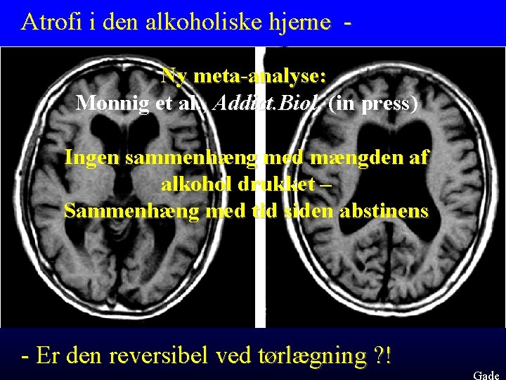 Atrofi i den alkoholiske hjerne Ny meta-analyse: Monnig et al. , Addict. Biol. (in