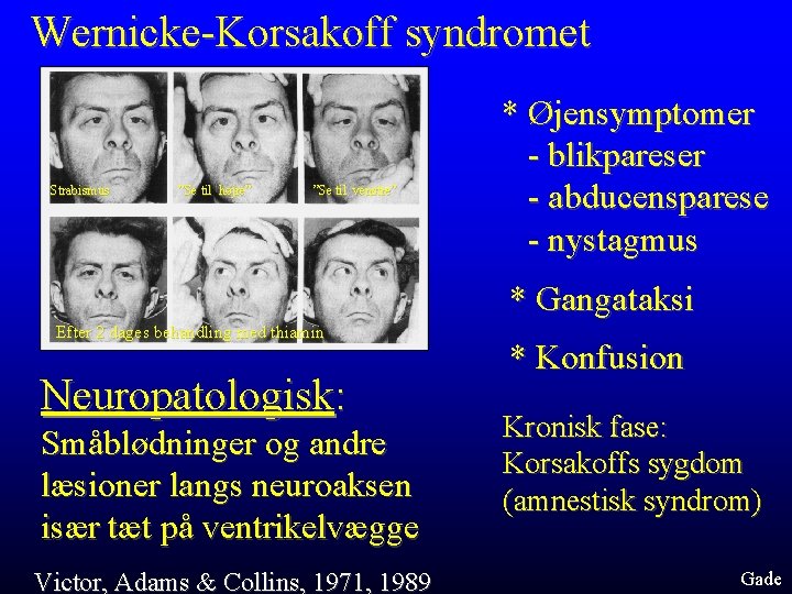 Wernicke-Korsakoff syndromet Strabismus ”Se til højre” ”Se til venstre” * Øjensymptomer - blikpareser -