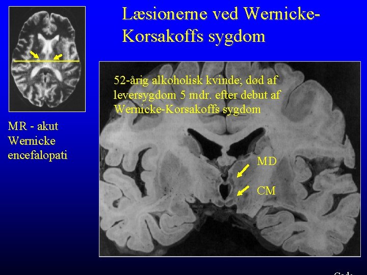 Læsionerne ved Wernicke. Korsakoffs sygdom 52 -årig alkoholisk kvinde; død af leversygdom 5 mdr.