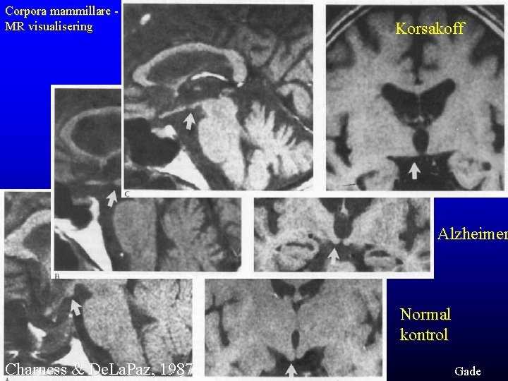 Corpora mammillare MR visualisering Korsakoff Alzheimer Normal kontrol Charness & De. La. Paz, 1987