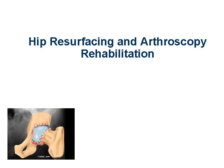 Hip Resurfacing and Arthroscopy Rehabilitation 