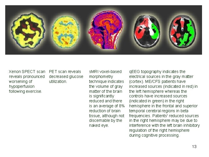 Xenon SPECT scan PET scan reveals pronounced decreased glucose worsening of utilization. hypoperfusion following