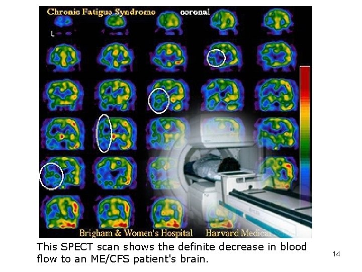 This SPECT scan shows the definite decrease in blood flow to an ME/CFS patient's