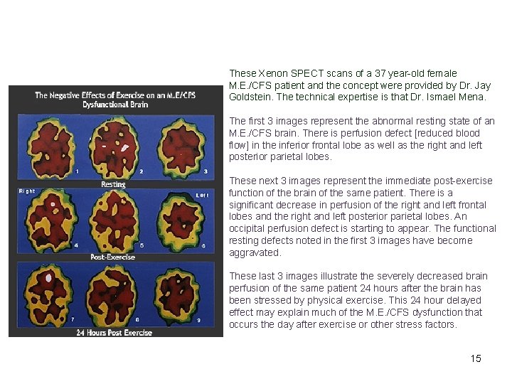 These Xenon SPECT scans of a 37 year-old female M. E. /CFS patient and