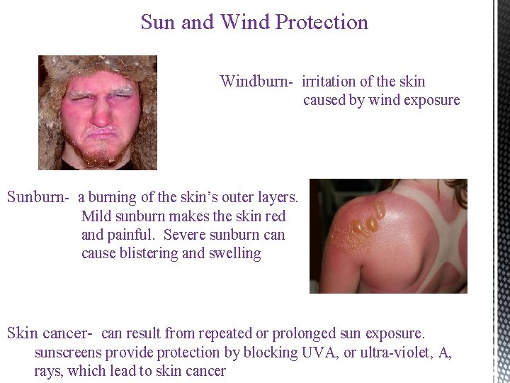 Sun and Wind Protection Windburn- irritation of the skin caused by wind exposure Sunburn- Sun and Wind Protection Windburn- irritation of the skin caused by wind exposure Sunburn-