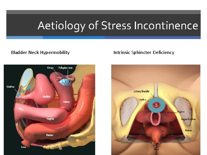 Aetiology of Stress Incontinence Bladder Neck Hypermobility Intrinsic Sphincter Deficiency 