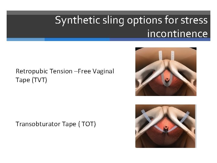 Synthetic sling options for stress incontinence Retropubic Tension –Free Vaginal Tape (TVT) Transobturator Tape
