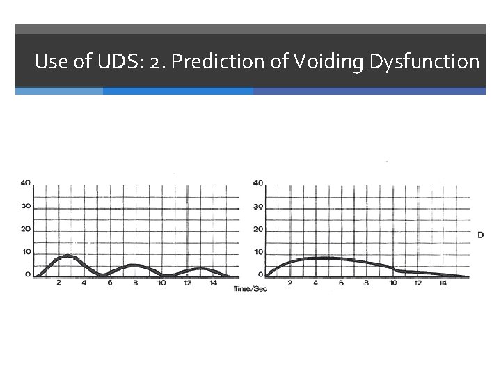 Use of UDS: 2. Prediction of Voiding Dysfunction 