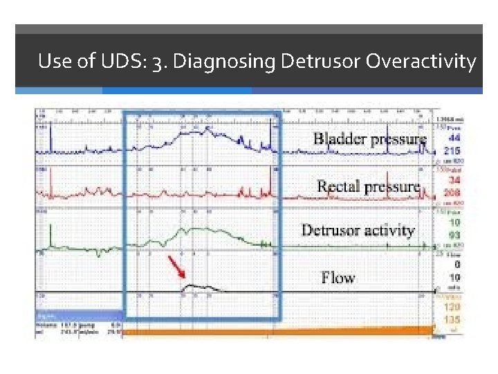 Use of UDS: 3. Diagnosing Detrusor Overactivity 