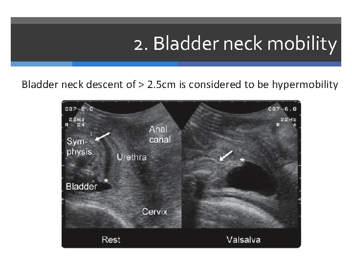 2. Bladder neck mobility Bladder neck descent of > 2. 5 cm is considered