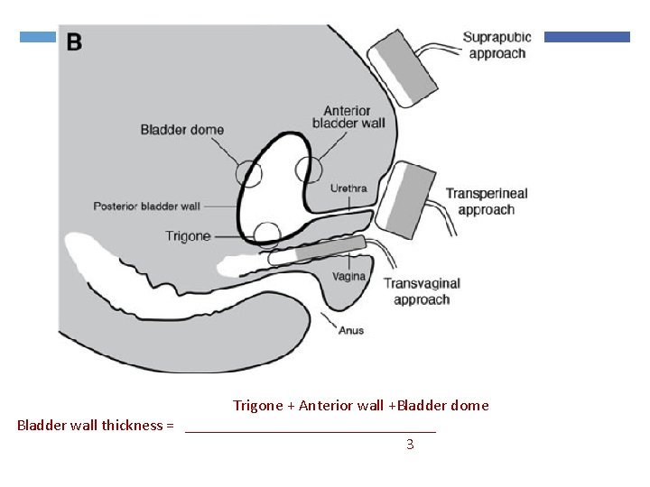 Trigone + Anterior wall +Bladder dome Bladder wall thickness = ________________ 3 