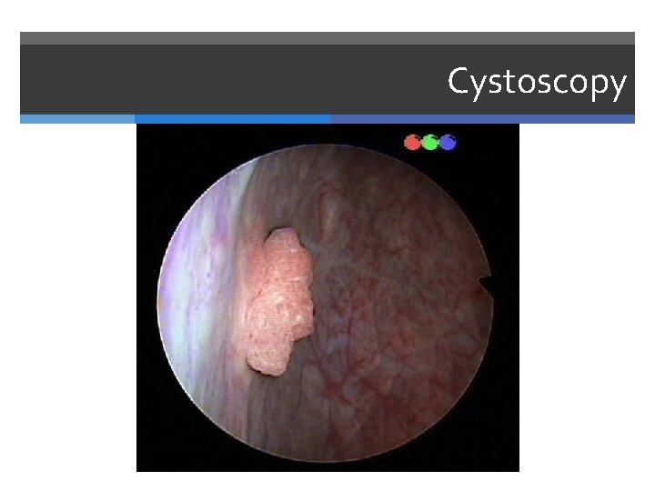 Cystoscopy 