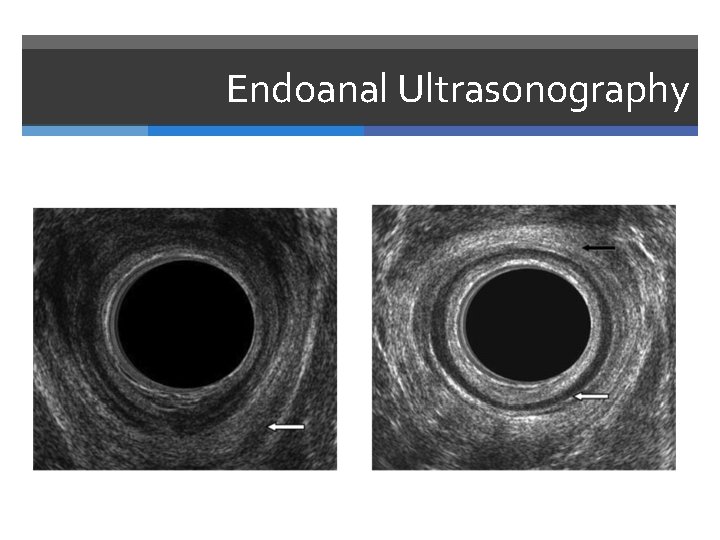 Endoanal Ultrasonography 