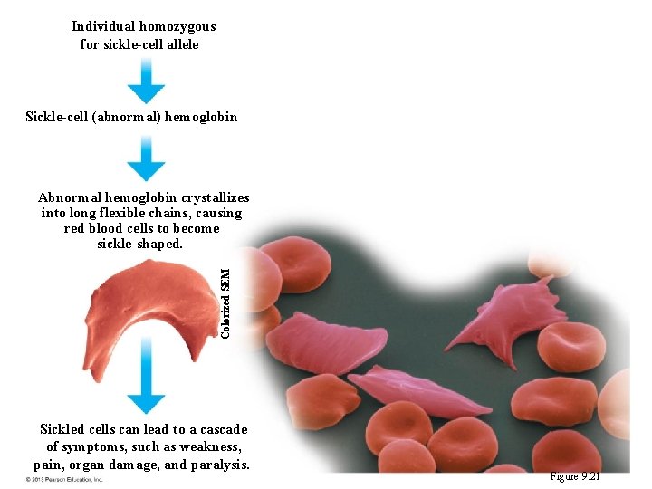 Individual homozygous for sickle-cell allele Sickle-cell (abnormal) hemoglobin Colorized SEM Abnormal hemoglobin crystallizes into