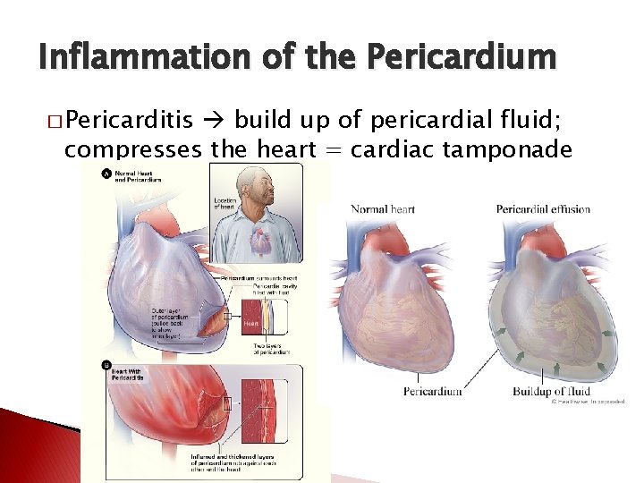 Inflammation of the Pericardium � Pericarditis build up of pericardial fluid; compresses the heart