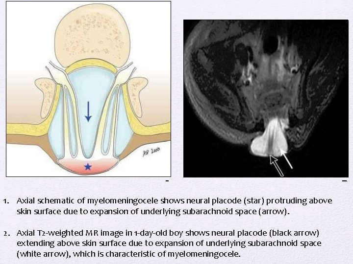 1. Axial schematic of myelomeningocele shows neural placode (star) protruding above skin surface due