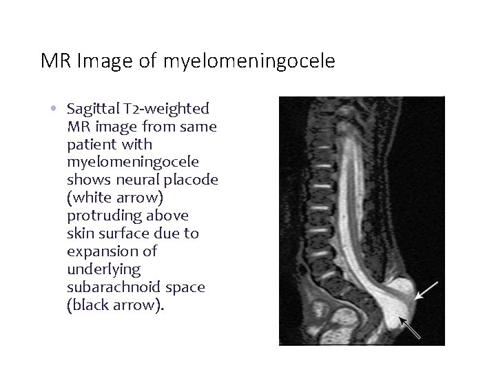 MR Image of myelomeningocele • Sagittal T 2 -weighted MR image from same patient