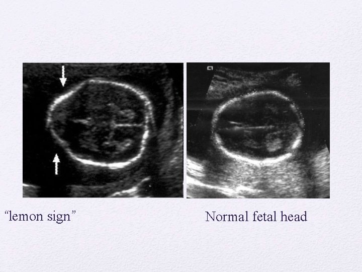 “lemon sign” Normal fetal head 