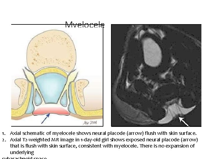 Myelocele 1. Axial schematic of myelocele shows neural placode (arrow) flush with skin surface.