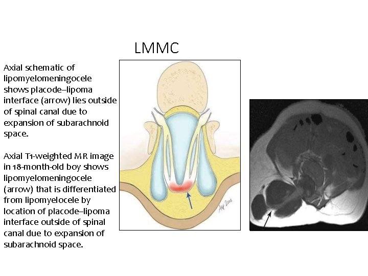 LMMC Axial schematic of lipomyelomeningocele shows placode–lipoma interface (arrow) lies outside of spinal canal