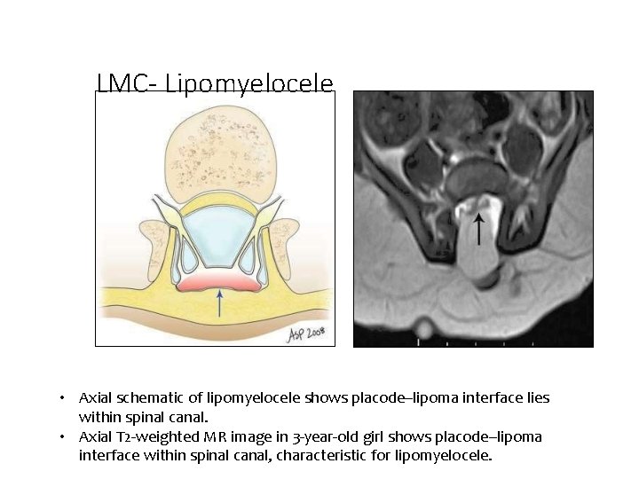 LMC- Lipomyelocele • Axial schematic of lipomyelocele shows placode–lipoma interface lies within spinal canal.