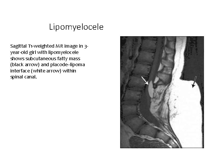 Lipomyelocele Sagittal T 1 -weighted MR image in 3 year-old girl with lipomyelocele shows